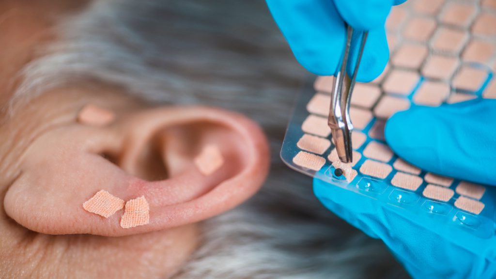 ¿Es la acupuntura efectiva para tratar el tinnitus?